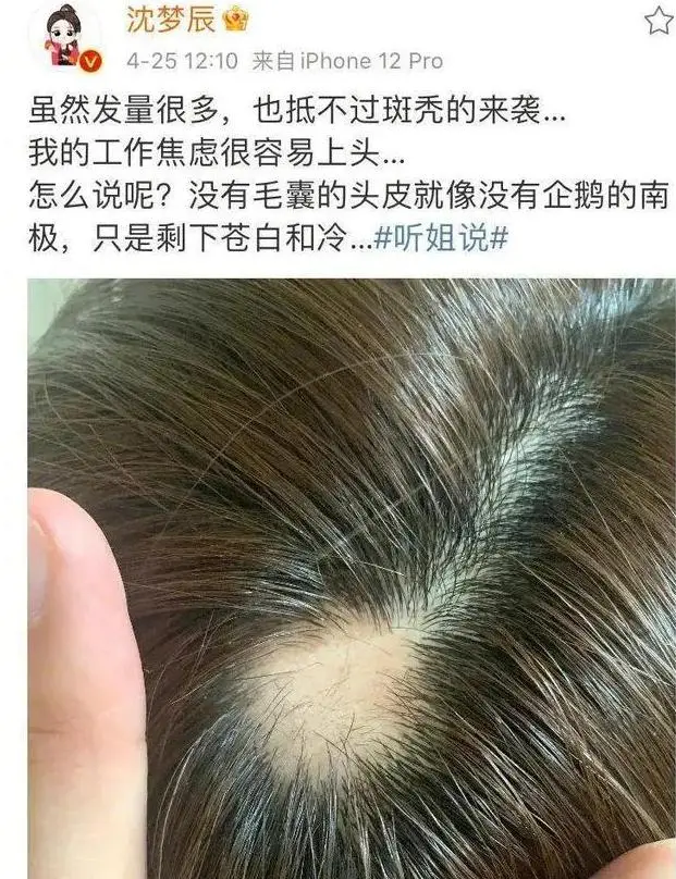 发量少的女明星有哪些_女明星脱发严重_杨幂赵丽颖金晨假发片